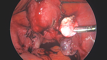 Large Multiple Uterine Fibroids and Endometriosis.